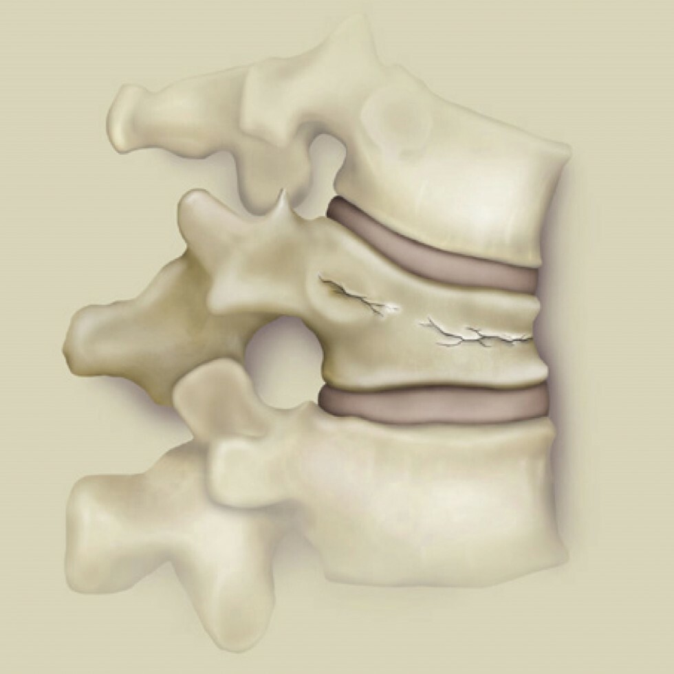 vertebral compression fracture model